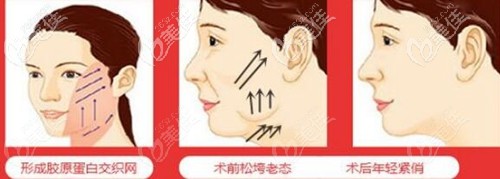 面部埋線提升的效果