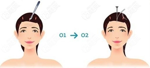 額頭抬頭紋能做拉皮手術(shù)嗎 額頭抬頭紋能做拉皮手術(shù)嗎