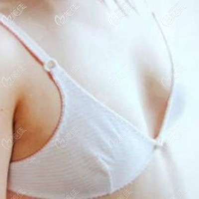 在武漢卓美做假體隆胸前照片 在武漢卓美做假體隆胸前照片