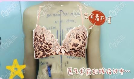 卓美吳秀英醫(yī)生給我胸部術(shù)前設(shè)計(jì)劃線 卓美吳秀英醫(yī)生給我胸部術(shù)前設(shè)計(jì)劃線