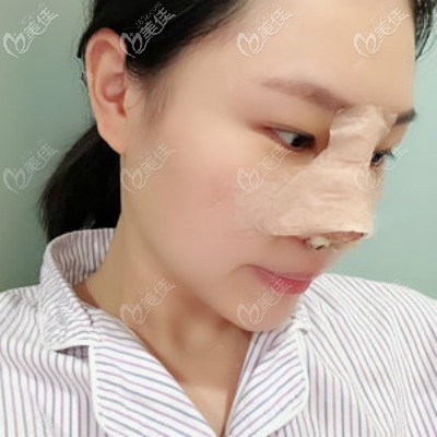 在武漢亞韓找鄧正輝醫(yī)生做自體肋骨隆鼻術(shù)后第3天