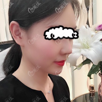 花3萬(wàn)在亞韓做自體骨隆鼻10天<span style=