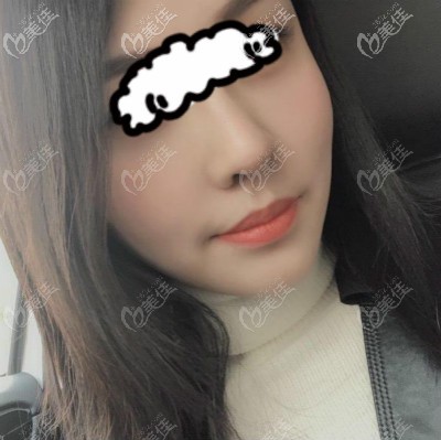 餅臉塌鼻,到武漢亞韓做自體肋骨隆鼻后感覺臉都變小了,3萬真沒白花！