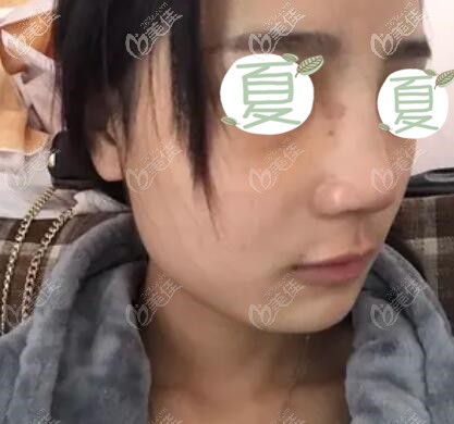 鼻綜合術(shù)后第8天拆線 鼻綜合術(shù)后第8天拆線