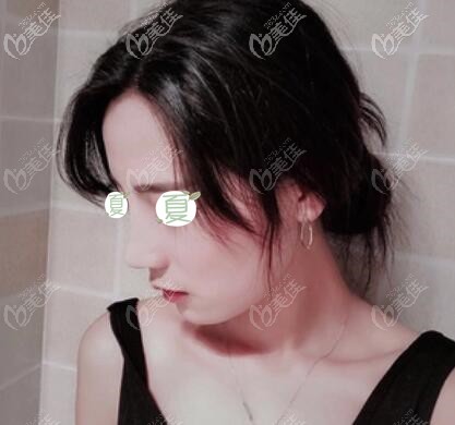 給你們看下我在長沙星雅做的多維立體綜合隆鼻26天恢復(fù)效果還不錯吧！