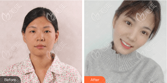 北京全切雙眼皮多少錢？花3萬多找北京美萊王鶴做的全切雙眼皮案例效果展示