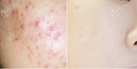 點(diǎn)陣激光祛痘術(shù)前術(shù)后對(duì)比圖 點(diǎn)陣激光祛痘術(shù)前術(shù)后對(duì)比圖