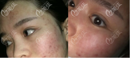 點(diǎn)陣激光祛痘術(shù)前術(shù)后對(duì)比圖 點(diǎn)陣激光祛痘術(shù)前術(shù)后對(duì)比圖