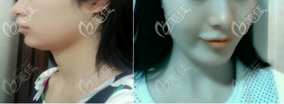 自體脂肪填充下巴一個(gè)月后的效果圖 自體脂肪填充下巴一個(gè)月后的效果圖