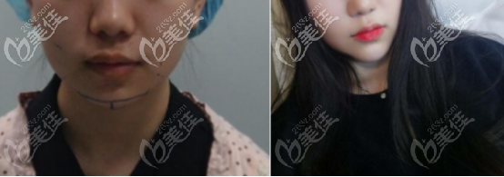 自體脂肪填充下巴一個(gè)月后的術(shù)前術(shù)后對比效果圖 自體脂肪填充下巴一個(gè)月后的術(shù)前術(shù)后對比效果圖