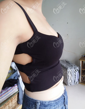 花了不到兩萬在濟(jì)寧找了家自體脂肪豐胸技術(shù)靠前的醫(yī)院做了手術(shù)