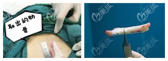 鼻綜合用的半肋骨和全肋骨