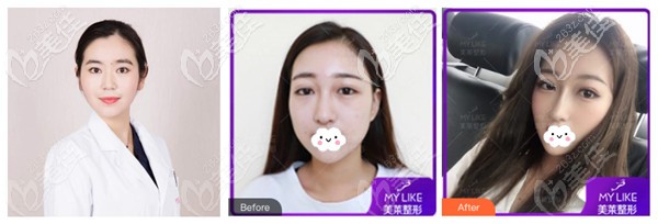 齊一帆醫(yī)生做肋軟骨隆鼻前后對比