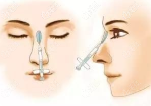 注射隆鼻示意圖