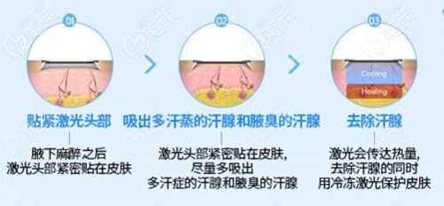 miraDry治療原理 miraDry治療原理