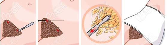 腰腹吸脂手術(shù)過(guò)程