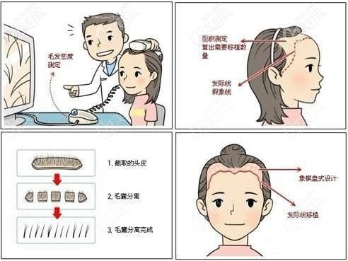 植發(fā)手術(shù)改善發(fā)際線高的問題