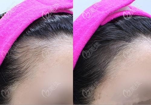 紋發(fā)際線的效果展示