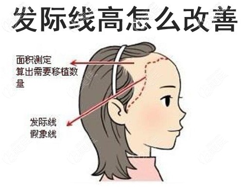 發(fā)際線高怎么改善