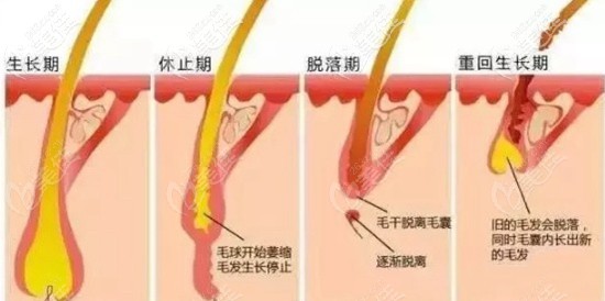 毛發(fā)移植手術(shù)后的脫落期 毛發(fā)移植手術(shù)后的脫落期