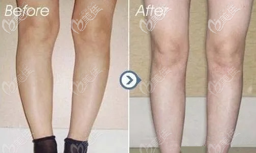 北京雅靚o型腿矯正案例效果 北京雅靚o型腿矯正案例效果