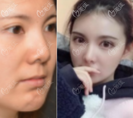 李勁良鼻小柱延長手術(shù)恢復(fù)30天的術(shù)前術(shù)后對比圖 李勁良鼻小柱延長手術(shù)恢復(fù)30天的術(shù)前術(shù)后對比圖