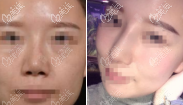 李勁良醫(yī)生做鼻小柱延長手術(shù)的案例 李勁良醫(yī)生做鼻小柱延長手術(shù)的案例