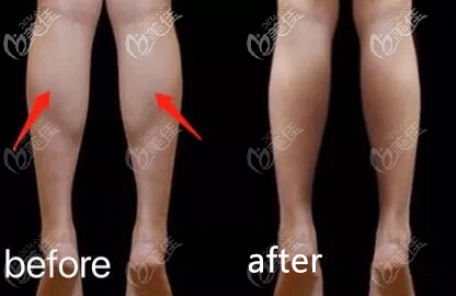 北京雅靚哪個醫(yī)生能做0型腿矯正 北京雅靚哪個醫(yī)生能做0型腿矯正