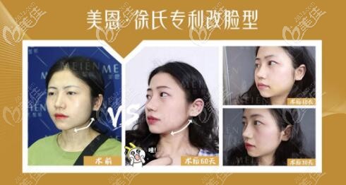 徐威強(qiáng)改臉型真人案例對(duì)比效果圖 徐威強(qiáng)改臉型真人案例對(duì)比效果圖