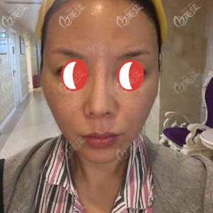 做脂肪膠填充全臉前顧客面部凹陷