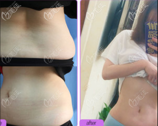 寧波美萊姚遠腰腹吸脂案例