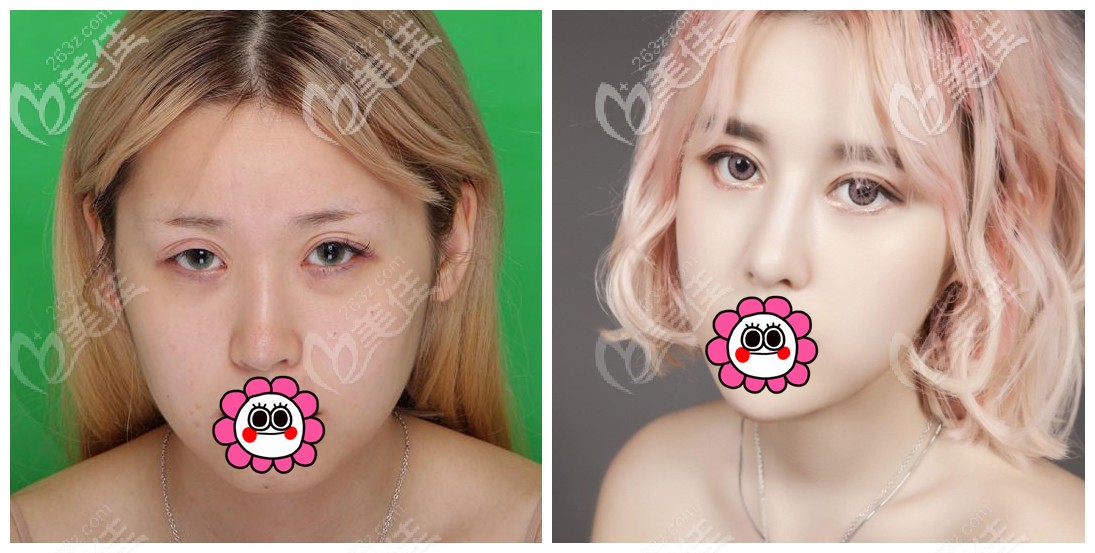 寧波薇琳張廣巍隆鼻案例