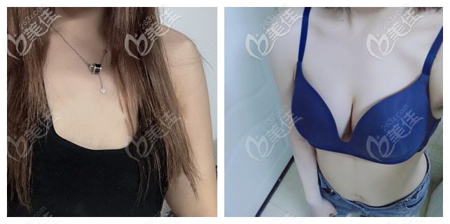 寧波薇琳曾舉假體隆胸案例