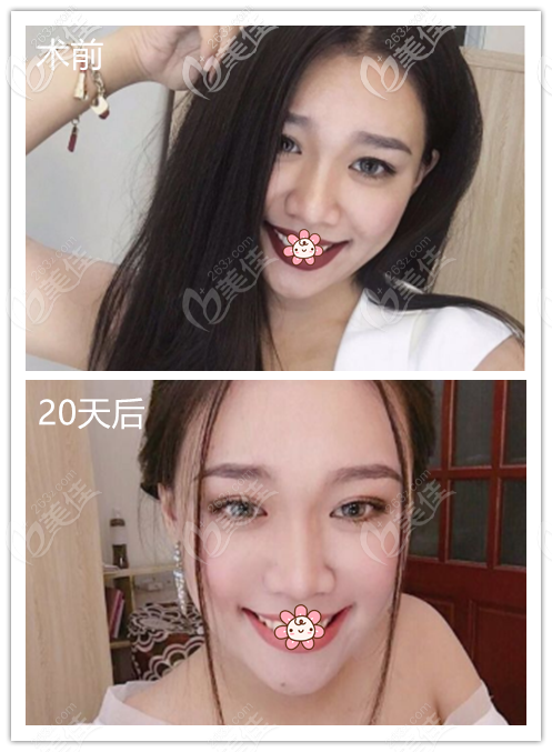 熱瑪吉去法令紋術(shù)前術(shù)后效果圖對比 熱瑪吉去法令紋術(shù)前術(shù)后效果圖對比