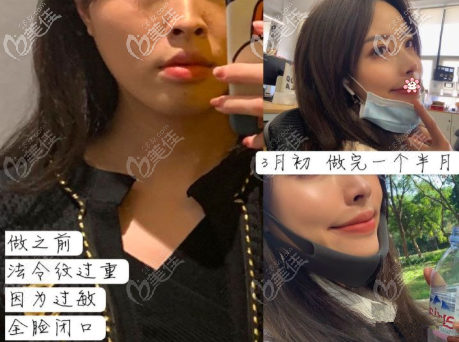 熱瑪吉去法令紋案例圖 熱瑪吉去法令紋案例圖