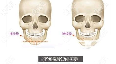 長(zhǎng)下巴截骨術(shù) 長(zhǎng)下巴截骨術(shù)