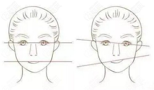 面部歪斜的自測方法 面部歪斜的自測方法