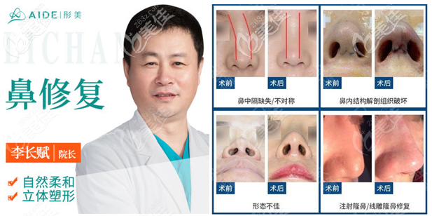 <!--<i data=20240703-sp></i>--><!--<i data=20240703-sp></i>-->鼻修復(fù)<span style=