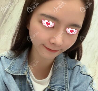 注射瘦臉術(shù)前照 注射瘦臉術(shù)前照