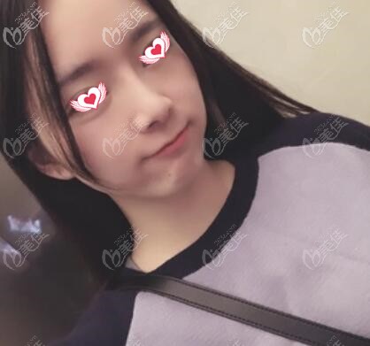 注射進口瘦臉術(shù)后28天效果照 注射進口瘦臉術(shù)后28天效果照