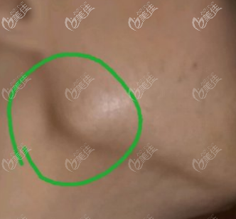 下頜角外翻圖 下頜角外翻圖