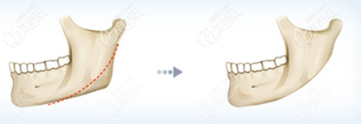 下頜角手術(shù)效果 下頜角手術(shù)效果