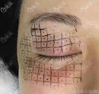 眼部熱瑪吉的治療