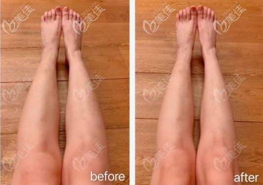 脂肪型小腿抽脂術(shù)前術(shù)后樣子 脂肪型小腿抽脂術(shù)前術(shù)后樣子