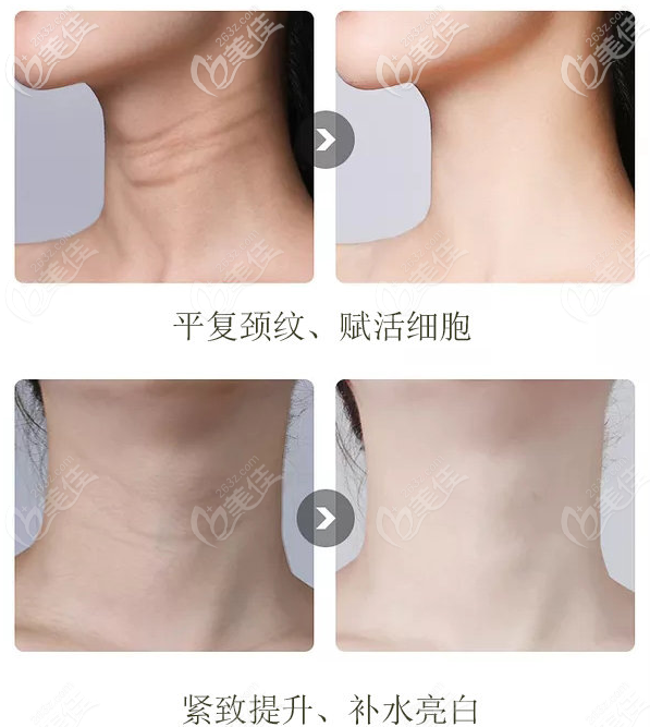 熱瑪吉和嗨體去頸紋哪個(gè)效果好 熱瑪吉和嗨體去頸紋哪個(gè)效果好