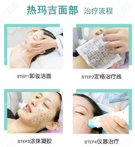 面部熱瑪吉治療流程圖 面部熱瑪吉治療流程圖