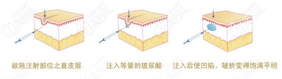 玻尿酸填充原理 玻尿酸填充原理