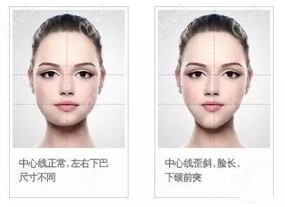 下巴歪斜的矯正方法 下巴歪斜的矯正方法