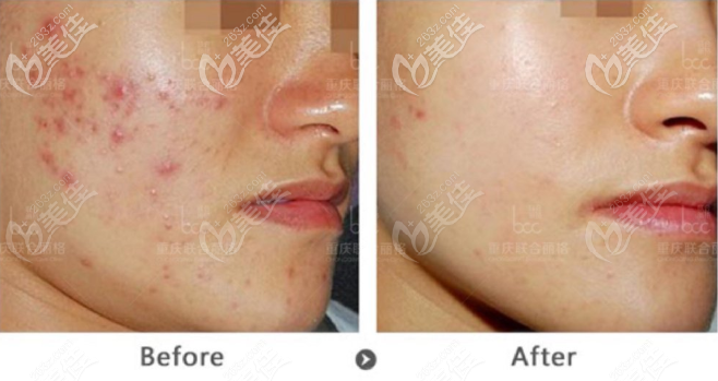 重慶聯(lián)合麗格M22祛痘印效果