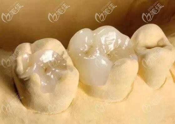 嵌體修復(fù) 嵌體修復(fù)